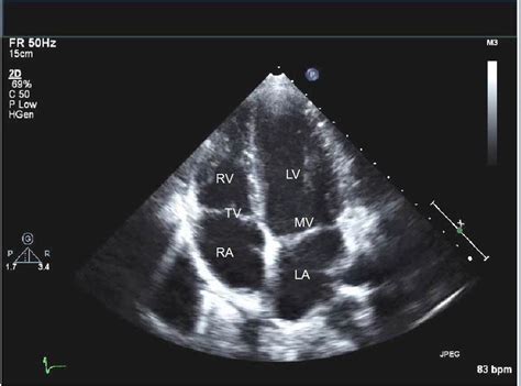 how to read echocardiogram|what does a normal echocardiogram look like.